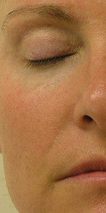 Nasal_Fold_2_After_5_HydraFacial_and_Red_Light_Treatments-150x300-150x300