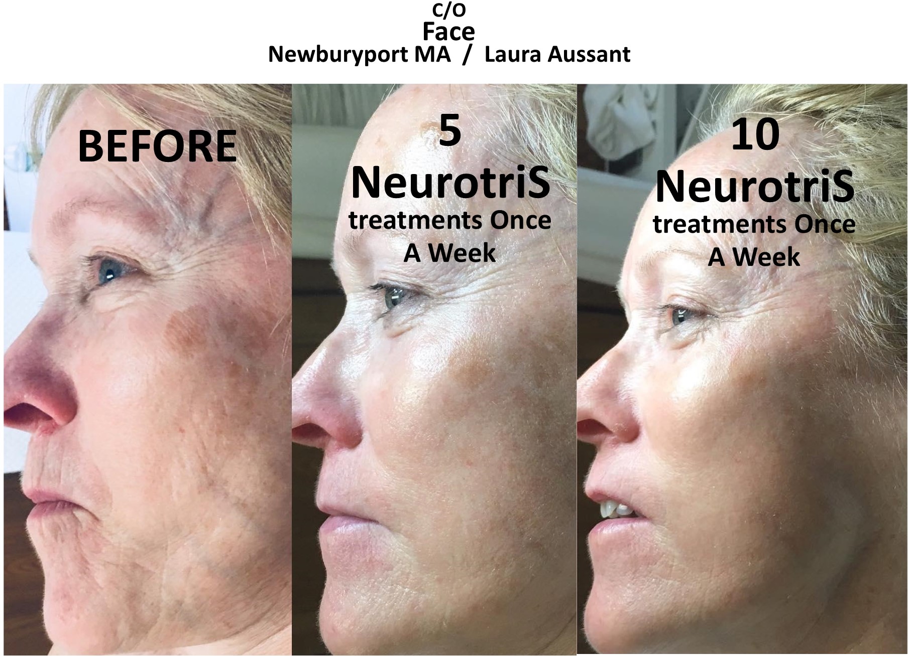 Neurotris-FACES-Before-After